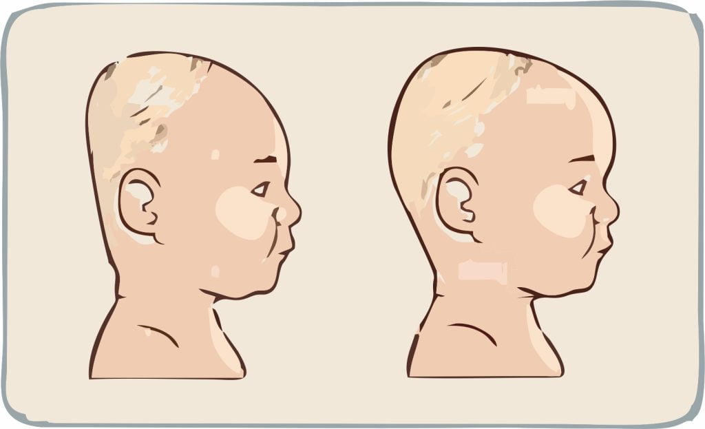 Πλαγιοκεφαλία